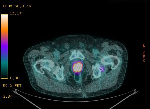 Appendiceal adenocarcinoma complicated by retroperitoneal abscess (Radiopaedia 58007-65041 Axial PET-CT 191).jpg