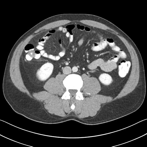 File:Appendicitis with cecal bar sign (Radiopaedia 31878-32830 B 44).jpg