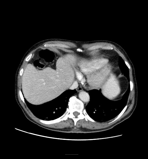 Appendicitis with localized perforation and abscess formation (Radiopaedia 49035-54130 A 17).jpg