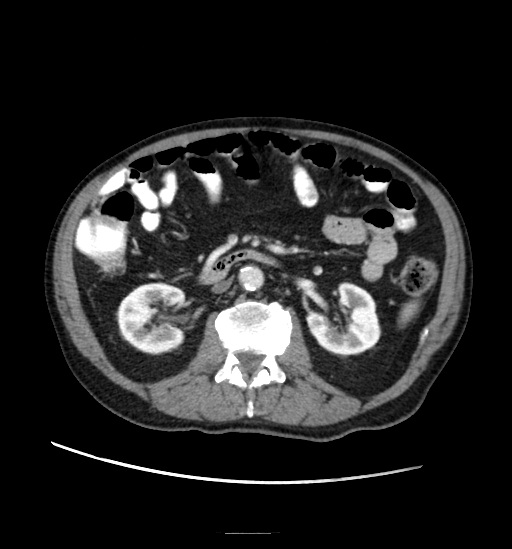 Appendicitis with localized perforation and abscess formation (Radiopaedia 49035-54130 A 42).jpg