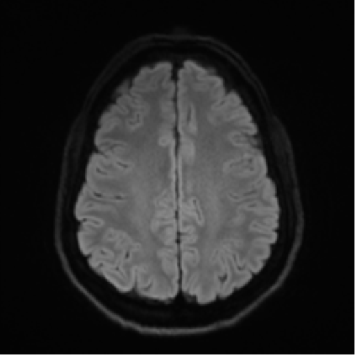 Arachnoid cyst - cerebellopontine angle (Radiopaedia 59689-67083 Axial DWI 62).png