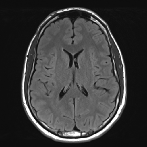 File:Arachnoid cyst - cerebellopontine angle (Radiopaedia 59689-67083 Axial FLAIR 22).png
