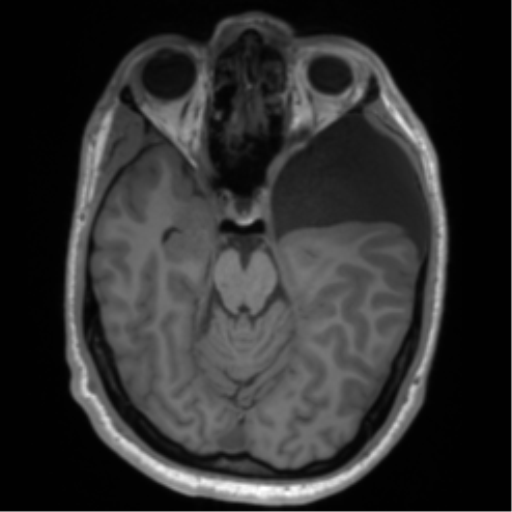 File:Arachnoid cyst with subdural hematoma (Radiopaedia 85892-101743 Axial T1 35).png