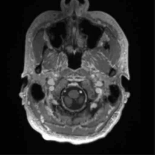 File:Arachnoid cyst with subdural hematoma (Radiopaedia 85892-101743 Axial T1 C+ 10).png