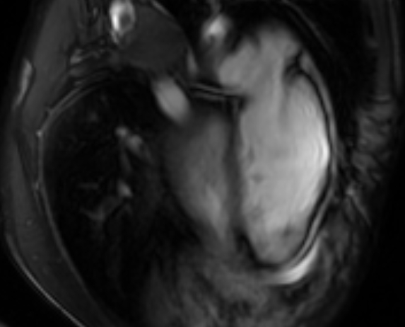Arrhythmogenic right ventricular cardiomyopathy (Radiopaedia 69564-79464 4ch cine 133).jpg