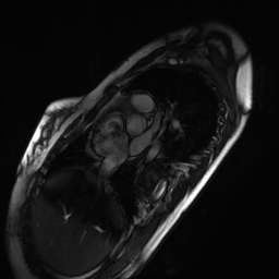 Arrhythmogenic right ventricular cardiomyopathy (Radiopaedia 87505-103850 short axis Cine SSFP 264).jpg