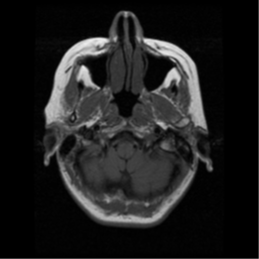 File:Arteriovenous malformation (cerebral) (Radiopaedia 40070-42580 Axial T1 2).png