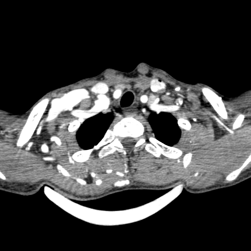 Arteriovenous malformation of the neck (Radiopaedia 53935-60062 A 2).jpg
