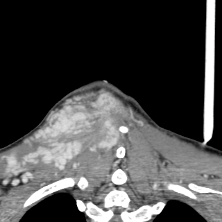 Arteriovenous malformation of the neck (Radiopaedia 53935-60062 D 58).jpg