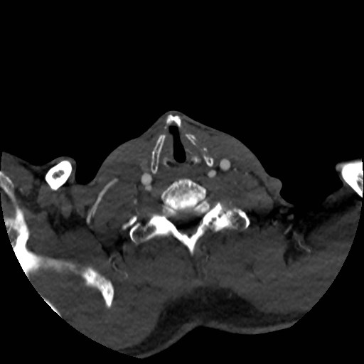 Artery of Percheron infarct (Radiopaedia 48088-52894 A 44).jpg