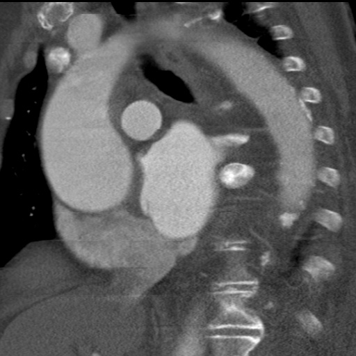 File:Ascending aortic aneurysm (Radiopaedia 20913-20846 A 21).jpg
