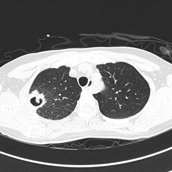 Aspergilloma (Radiopaedia 26223-26347 Axial lung window 19).jpg