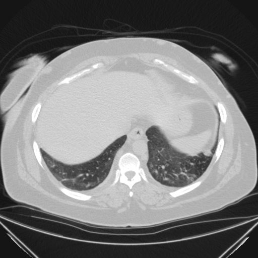 Aspergilloma (Radiopaedia 39611-41932 Axial lung window 111).jpg