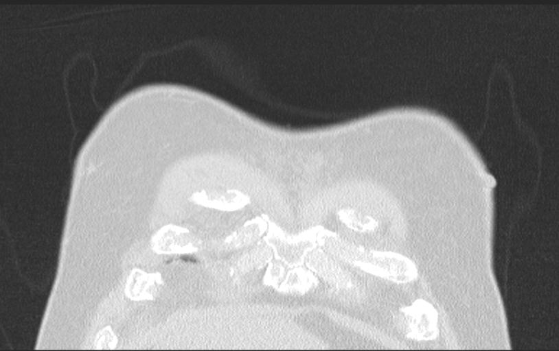Aspirated tooth (Radiopaedia 28584-28844 Axial lung window 22).jpg