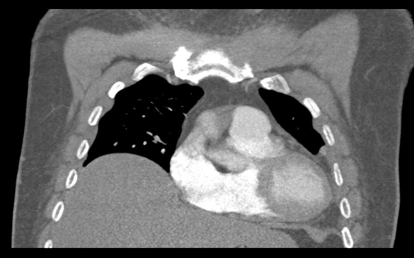 Aspirated tooth (Radiopaedia 28584-28844 Coronal C+ CTPA 22).jpg