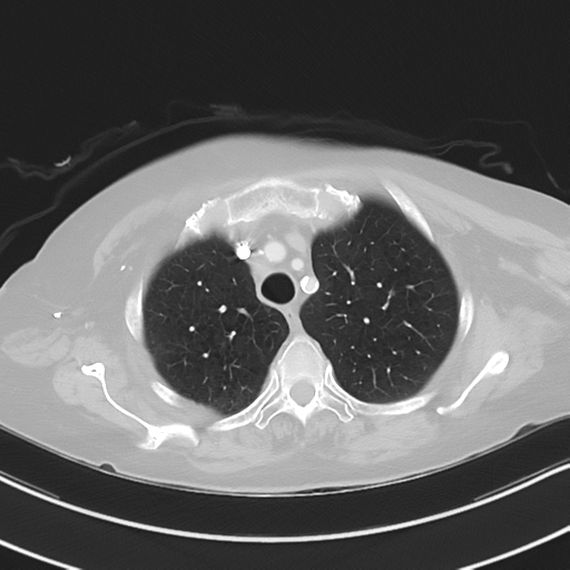 Aspiration bronchiolitis (Radiopaedia 53464-59463 Axial lung window 12).png