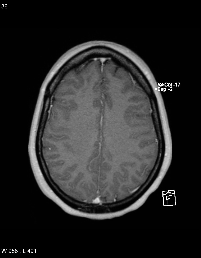 Astroblastoma (Radiopaedia 39792-42217 Axial T1 C+ 35).jpg