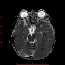 Astroblastoma (Radiopaedia 74287-85162 Axial ADC 19).jpg