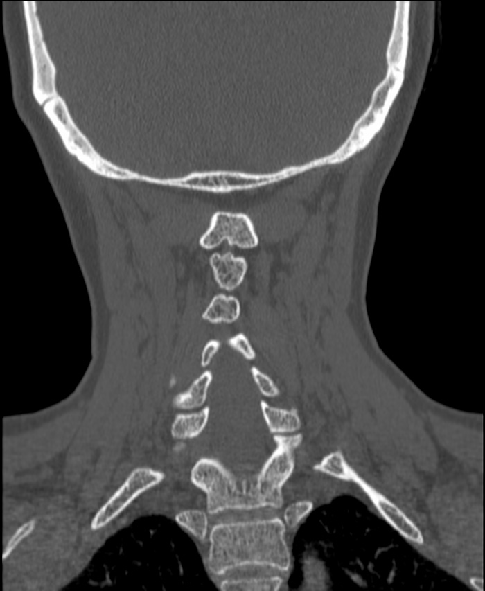 Atlanto-occipital assimilation with basilar invagination (Radiopaedia 70122-80188 Coronal bone window 165).jpg