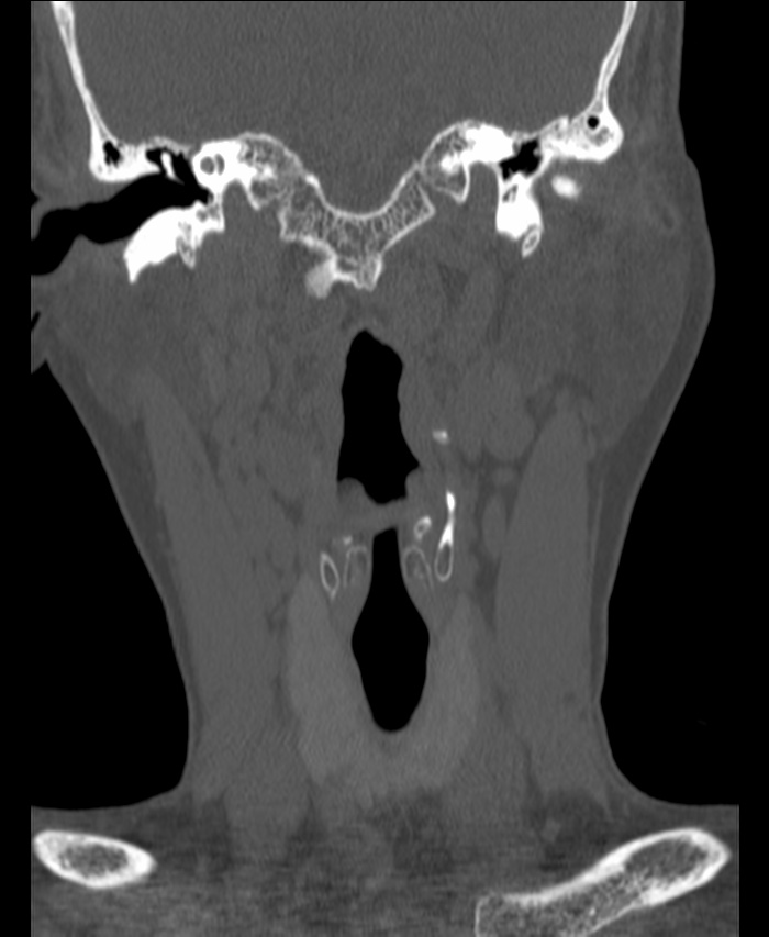 Atlanto-occipital assimilation with basilar invagination (Radiopaedia 70122-80188 Coronal bone window 34).jpg