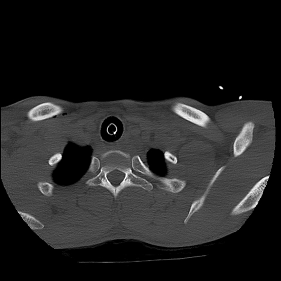 Atlanto-occipital dissociation (Traynelis type 1), C2 teardrop fracture, C6-7 facet joint dislocation (Radiopaedia 87655-104061 Axial bone window 92).jpg