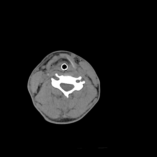 File:Atlanto-occipital dissociation (Traynelis type 1), C2 teardrop fracture, C6-7 facet joint dislocation (Radiopaedia 87655-104061 Axial non-contrast 51).jpg