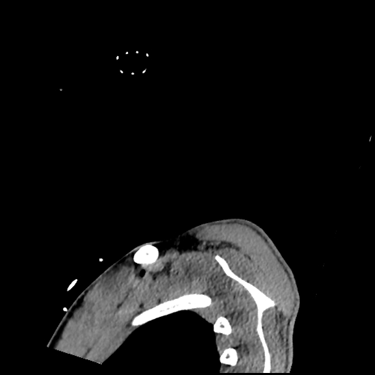 File:Atlanto-occipital dissociation (Traynelis type 1), C2 teardrop fracture, C6-7 facet joint dislocation (Radiopaedia 87655-104061 D 89).jpg