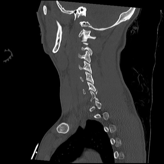 Atlanto-occipital dissociation (Traynelis type 1), C2 teardrop fracture, C6-7 facet joint dislocation (Radiopaedia 87655-104061 Sagittal bone window 49).jpg