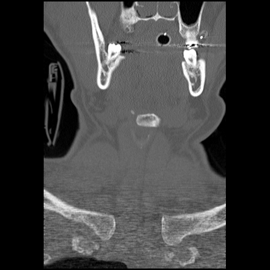Atlanto-occipital dissociation injury (Radiopaedia 29274-29698 Coronal bone window 54).png