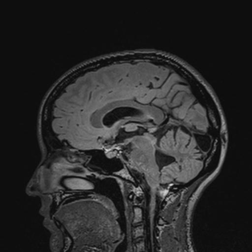 Atretic encephalocoele with inferior vermis hypoplasia (Radiopaedia 30443-31108 Sagittal FLAIR 81).jpg