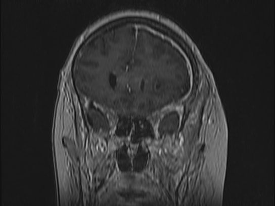 Atypical meningioma (Radiopaedia 62985-71406 Coronal T1 C+ 32).jpg