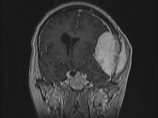Atypical meningioma (Radiopaedia 62985-71406 Coronal T1 C+ 49).jpg