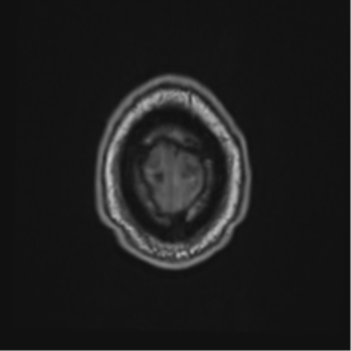 File:Atypical meningioma (WHO grade II) with brain invasion (Radiopaedia 57767-64729 Axial T1 50).png