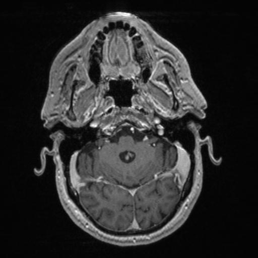 Atypical meningioma (grade II) - en plaque (Radiopaedia 29633-30147 Axial T1 C+ 51).jpg