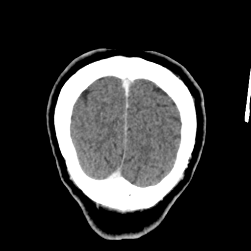 Atypical meningioma with skull invasion (Radiopaedia 34357-35649 Coronal C+ delayed 55).png