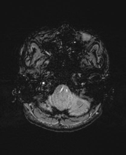 Autoimmune limbic encephalitis (Radiopaedia 30363-31005 SWI 10).jpg