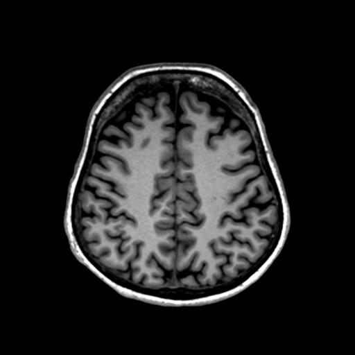 Autoimmune limbic encephalitis (Radiopaedia 30363-31005 T1 Axial 1mm 110).jpg