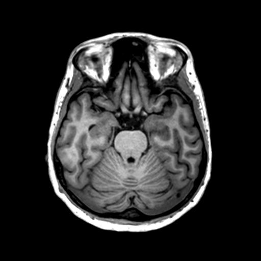 File:Autoimmune limbic encephalitis (Radiopaedia 30363-31005 T1 Axial 1mm 55).jpg