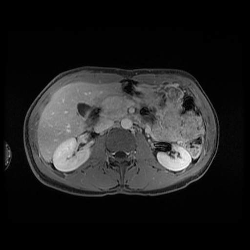 Autoimmune pancreatitis (Radiopaedia 69751-79729 Axial T1 C+ fat sat 72).jpg