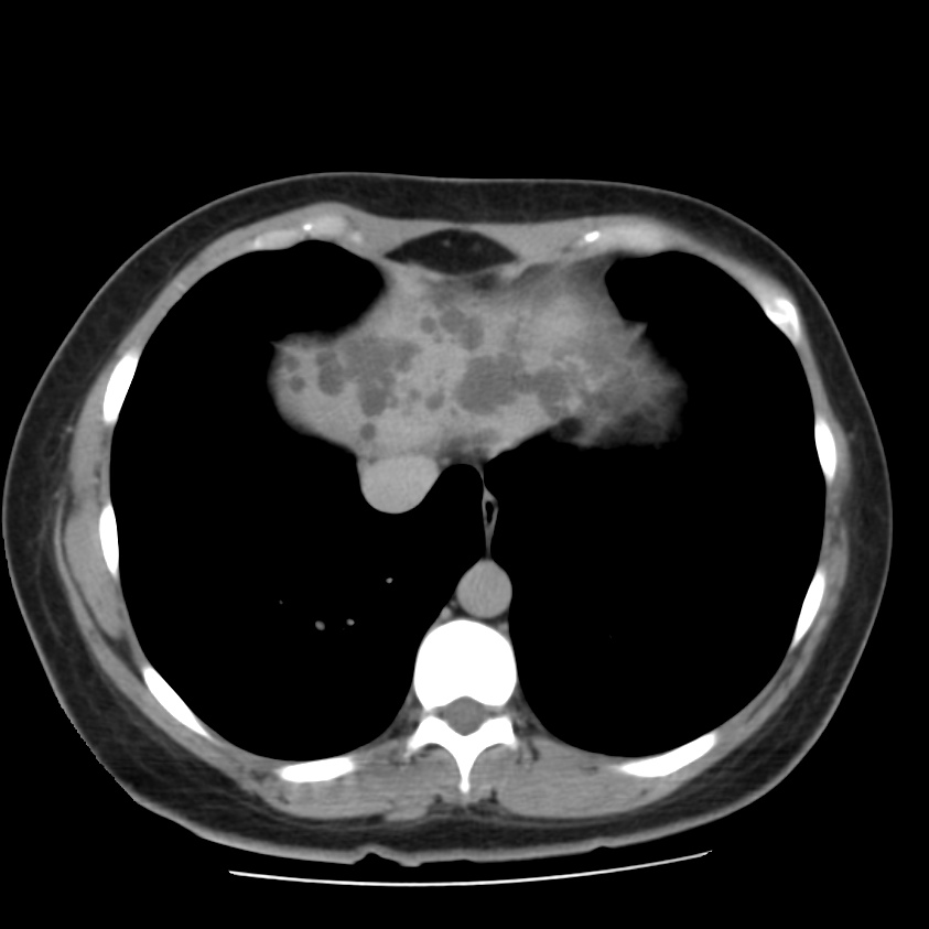 Autosomal dominant polycystic kidney disease (Radiopaedia 23061-23093 C+ delayed 5).jpg