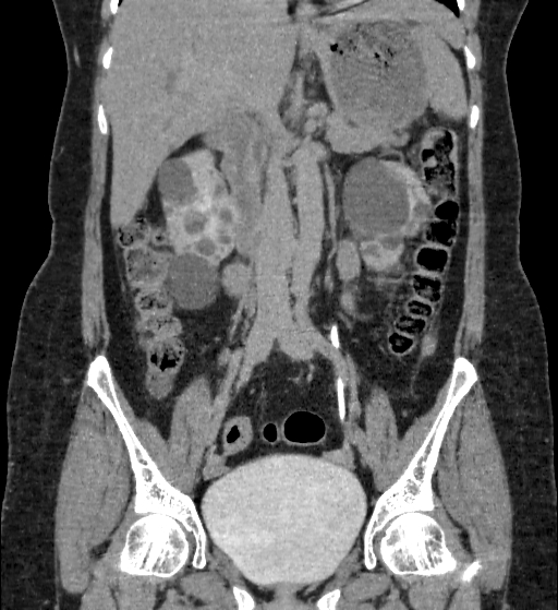 File:Autosomal dominant polycystic kidney disease (Radiopaedia 38189-40194 Coronal C+ delayed 42).jpg