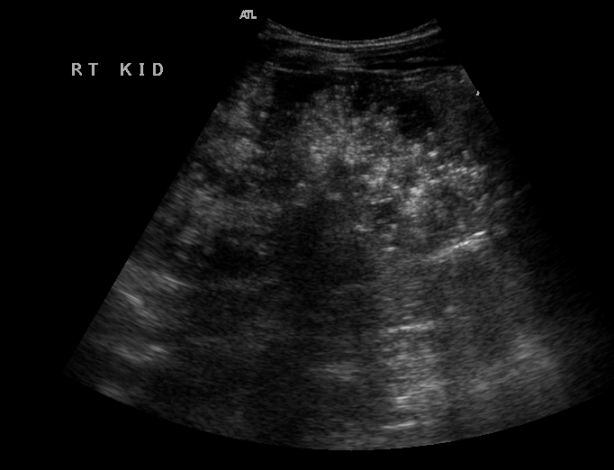 File:Autosomal recessive polycystic kidney disease (Radiopaedia 9487).jpg