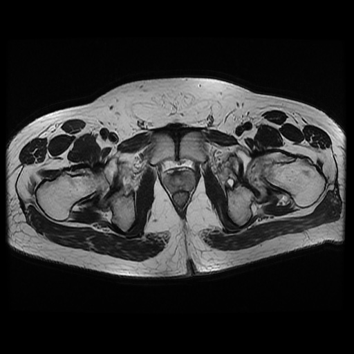 File:Avascular necrosis of the hip (Radiopaedia 61503-69465 T2 21).jpg