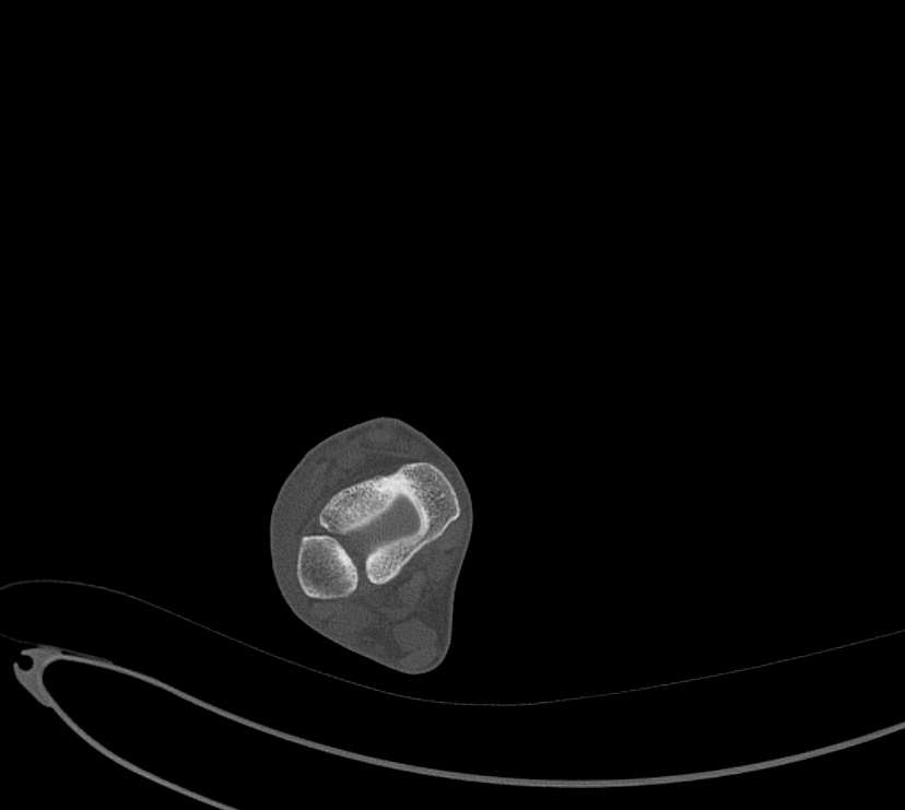 Avulsion fractures of talus and calcaneus (Radiopaedia 48277-53155 Axial bone window 2).jpg