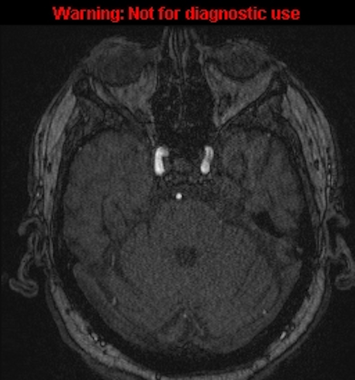 Azygos anterior cerebral artery (Radiopaedia 59325-66677 Axial MRA 46).jpg