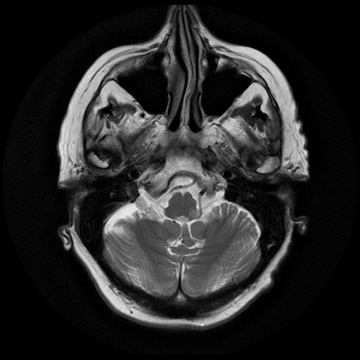 File:Balo concentric sclerosis (Radiopaedia 53875-59982 Axial T2 5).jpg