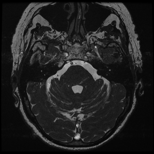 File:Balo concentric sclerosis (Radiopaedia 53875-59982 Axial T2 FIESTA 46).jpg