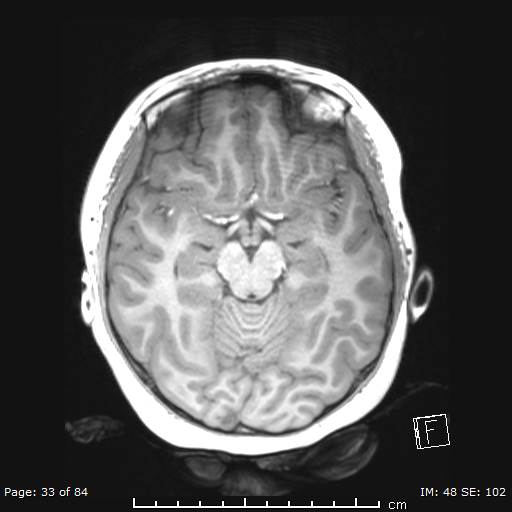 Balo concentric sclerosis (Radiopaedia 61637-69636 Axial T1 33).jpg