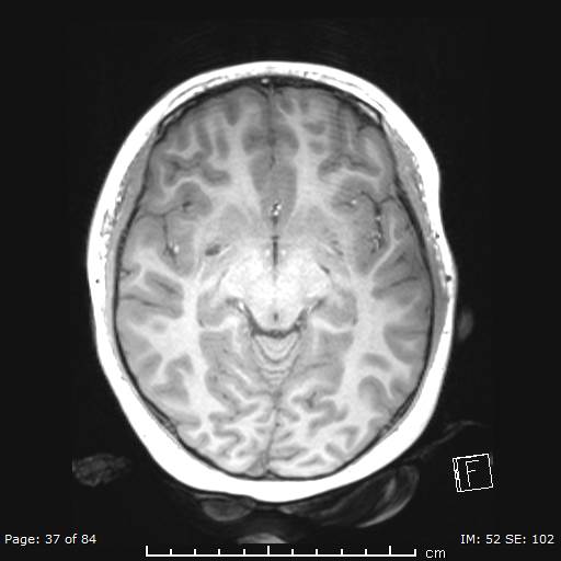 File:Balo concentric sclerosis (Radiopaedia 61637-69636 Axial T1 37).jpg