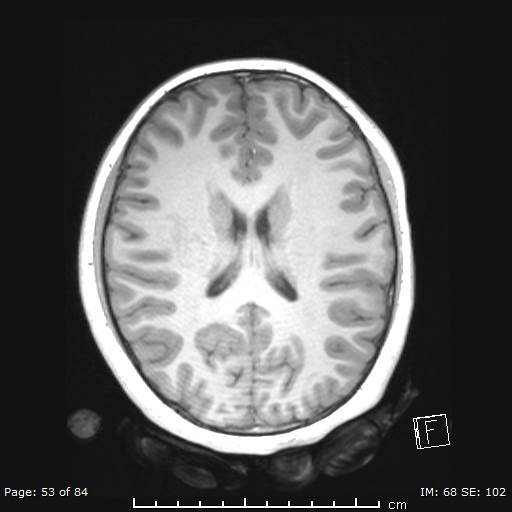 File:Balo concentric sclerosis (Radiopaedia 61637-69636 Axial T1 53).jpg